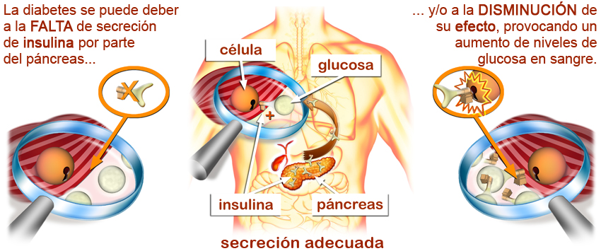 imagen en detalle de secreción de la glucosa en páncreas y la falta, disminución o inadecuado efecto de la glucosa en sangre