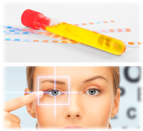 imágenes conceptuales de análisis orina para determinar microalbuminuria y prueba de control de salud visual